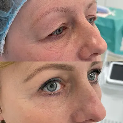 Tesoro Clinic Medycyna Estetyczna Chirurgia Plastyka powiek we Wrocławiu